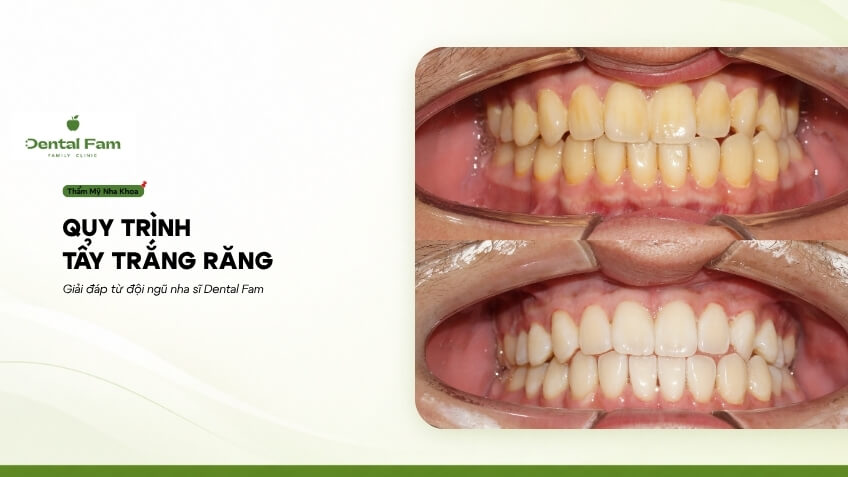 Процедура отбеливания зубов в клинике Dental Fam: стандартные медицинские этапы.