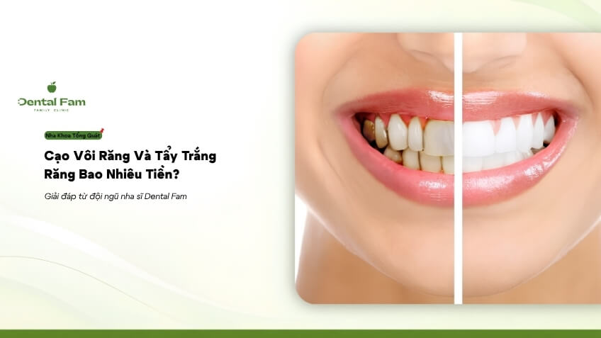 Сколько стоят чистка и отбеливание зубов? | Dental Fam