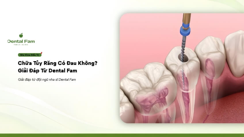 Болезненна ли процедура лечения корневых каналов? Ответы от Dental Fam