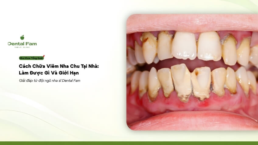 Домашние средства от пародонтита: что можно сделать и каковы ограничения?
